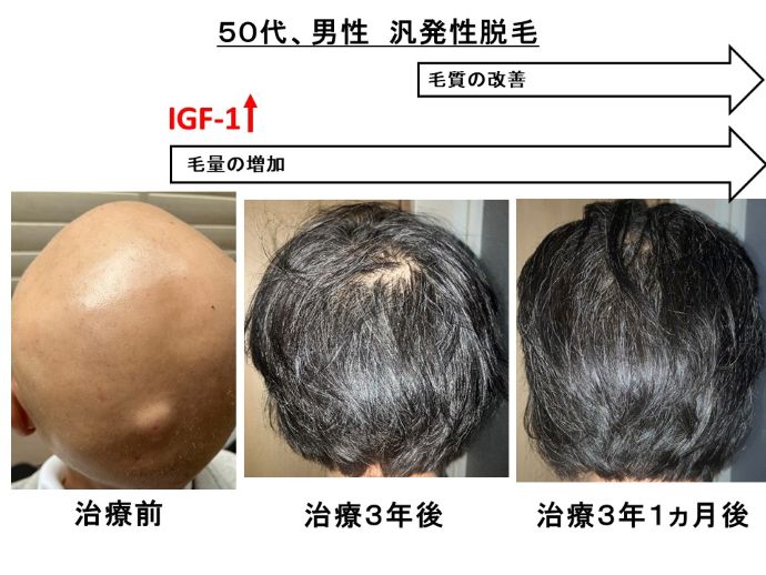 円形脱毛症　病院